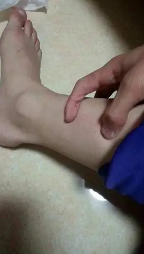 小腿这个部位疼痛,据老师说是疲劳性骨膜炎,后天中考体育,该用什么