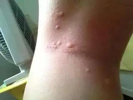 株洲人:被蚊子咬后千万不要这样做!当心有生命危险!_皮肤