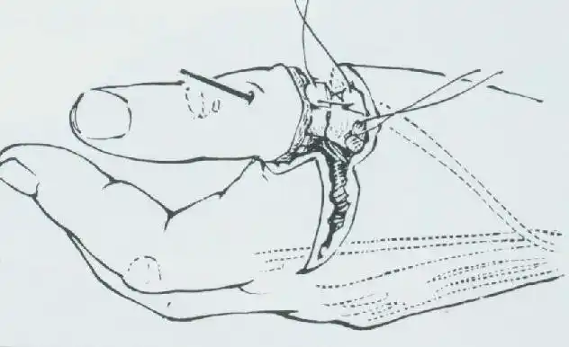 杭州邦尔骨科医院断肢再植手术大揭秘