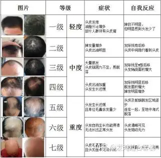 头顶稀疏算几级脱发? - 知乎