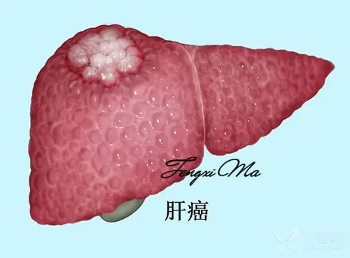 可能涉及到敏感图片,点击后可查看 查看 以上是肝炎---肝硬化---肝癌