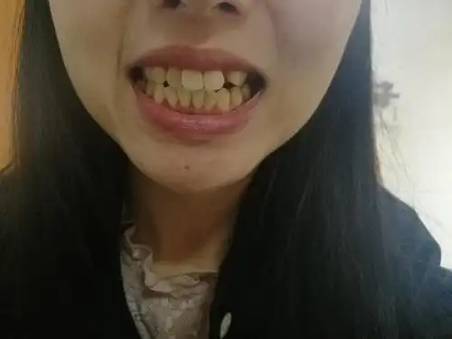 25岁女,牙齿拥挤,牙列不齐,中缝歪了4-5mm左右,门牙歪斜,前牙开合.