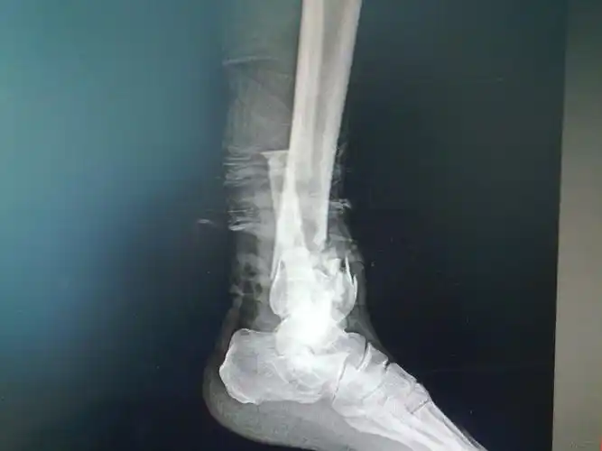 看看这个胫腓骨远端开放性粉碎性骨折治疗