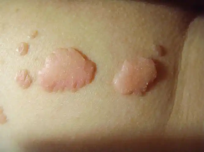 屁股上长的疣,前两年因为有了小孩子,没有去看,近两年也一直是这个