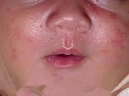 痤疮图片_痤疮症状表现图片大全_有来医生