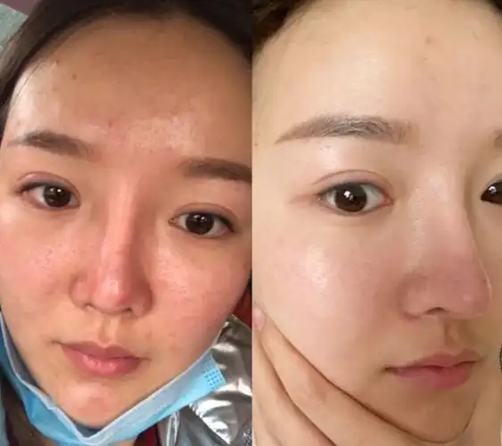 薇薇 在杜教授的指导下皮肤状态前后对比薇薇我是重度敏感肌,每到春