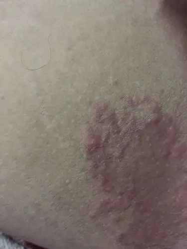 大腿内侧皮肤这样怎么回事,看起来好像有虫子形状