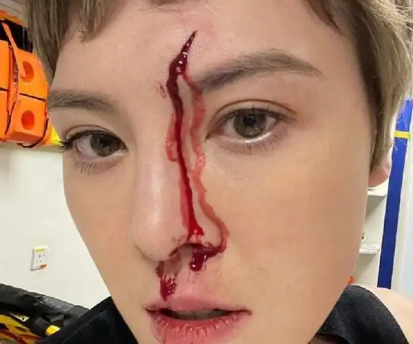 女星何慈茵高空拍戏受伤!