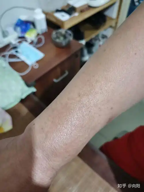 50左右手臂上的是否是老年斑