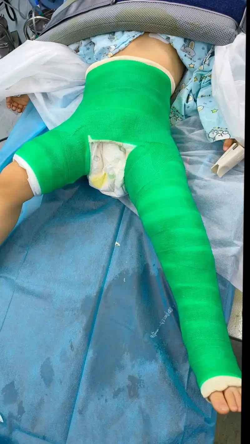 经典的下肢悬吊牵引两周,骨折断端可见骨伽后,戴支具或打石膏,就可以