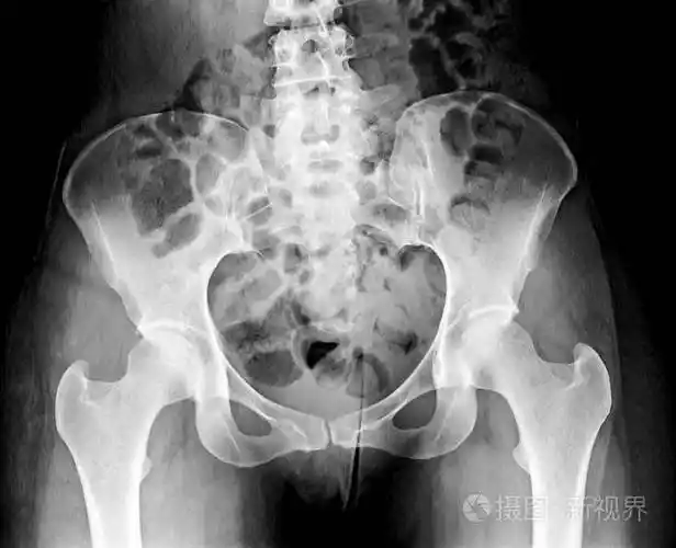 骨盆x线人类骨架图像