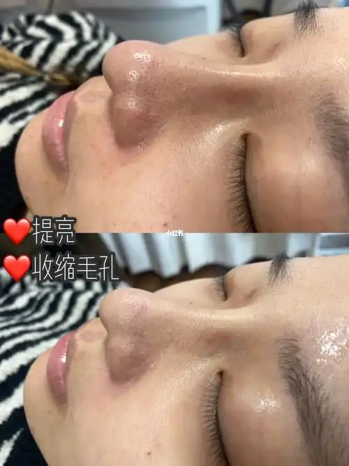 超光子嫩肤前后对比