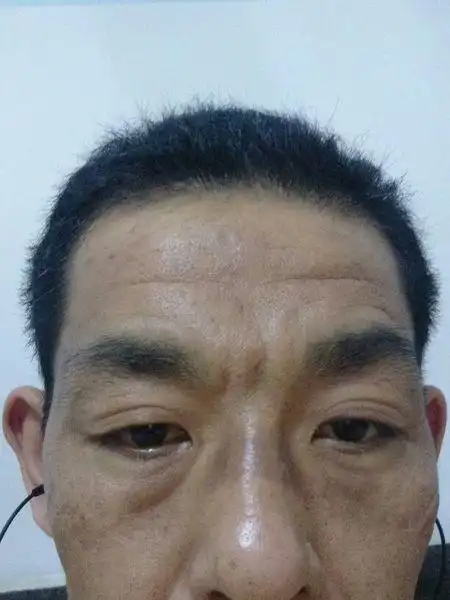 鼻梁上端及眼睛下面的皮肤呈现黑色是肾脏还是心脏出了问题?