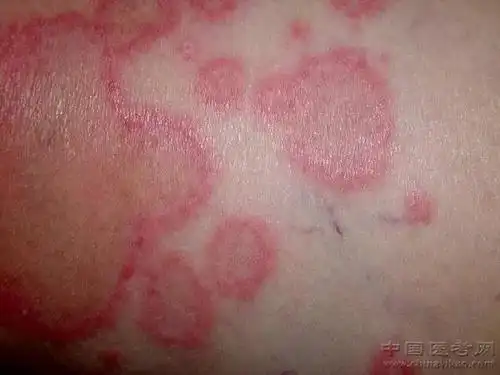 【史上最全】320张超珍贵皮肤病图谱!(修订版)!