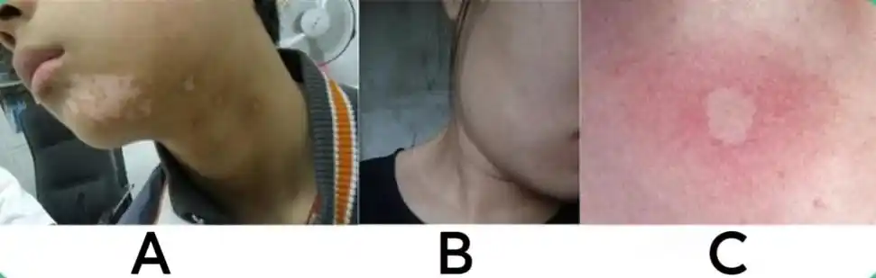 图上的3种白斑属于哪种皮肤病?