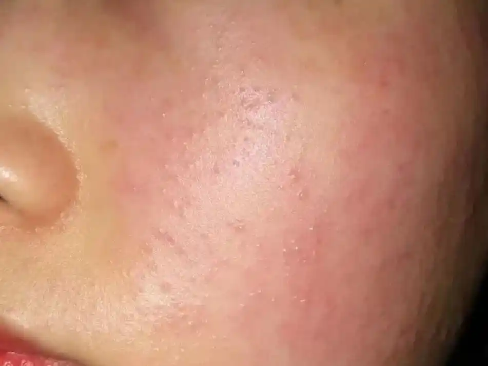 让你一次性全面了解敏感肌,小学生也能看懂!