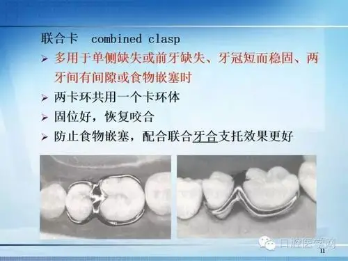 【多图】可摘局部义齿-卡环的种类