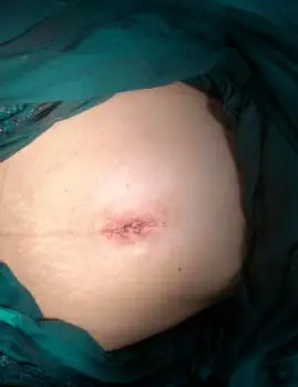 手术后脐部的缝合切口