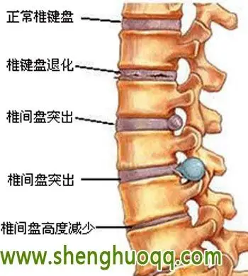 腰间盘突出保守治疗