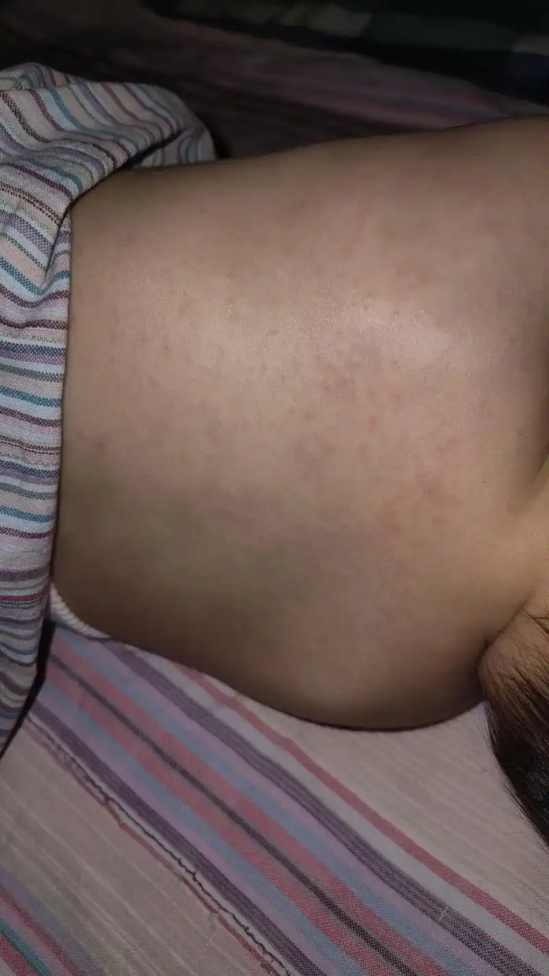 宝宝热疹.#全身起疹子 #心疼宝贝  昨晚孩子睡着就哭闹,无 - 抖音