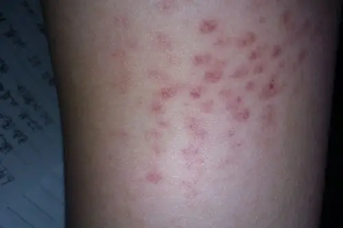胳膊上起了一大片红斑,不痛不痒_百度知道