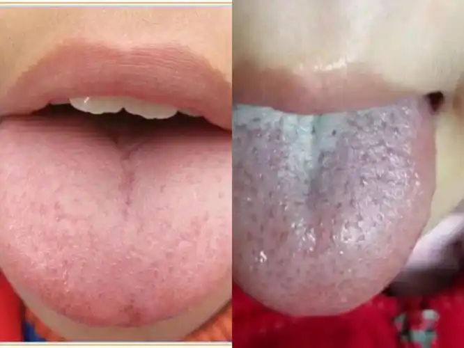 平常可以多观察一下孩子的舌头,看下有没有积食啊,内热,压力大的,等等