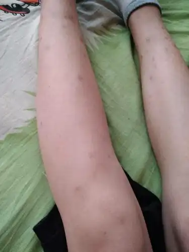 夏天快到了,腿上全是疤,很丑,我怕别人笑话所以一直没有穿短裤,怎么办