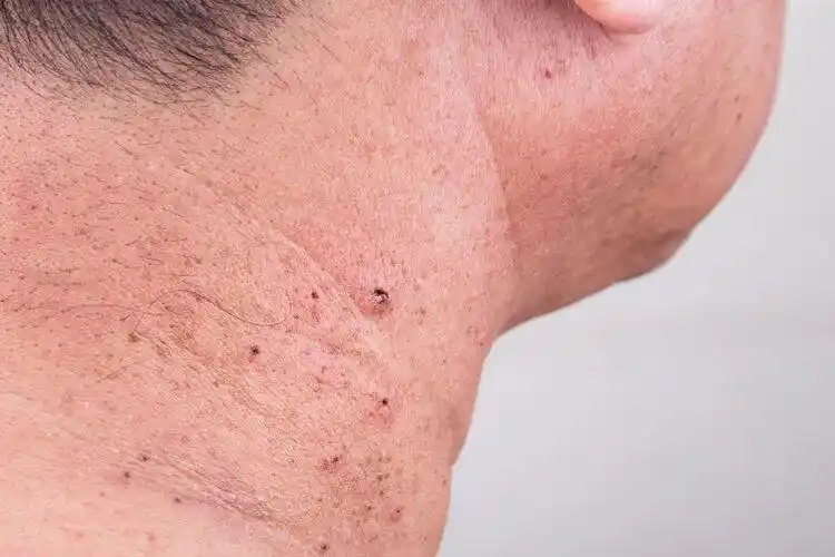 皮肤上长了小肉疙瘩?可能是hpv感染