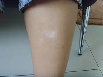 治疗白癜风更有效果:   一,坚持早期治疗原则:白癜风在发病早期面积小