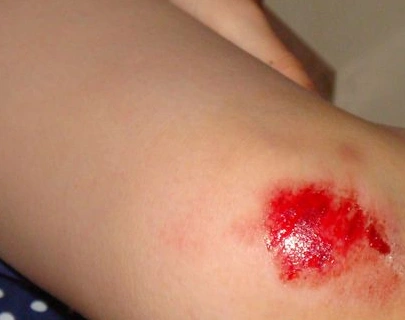 胳膊流血真实图片53