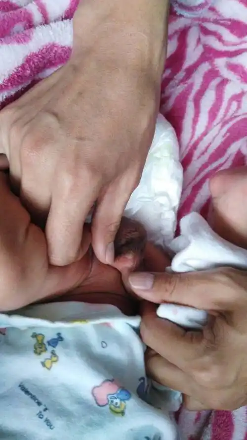 宝宝蛋蛋上有水泡,水泡已经破了,怎么办?