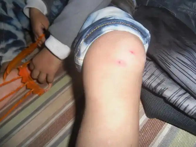 儿子的过敏性紫癜