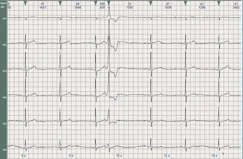 心电图学习20161115心动过缓