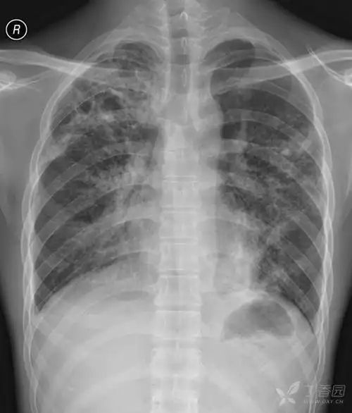 每周胸片92期观影识病肺结核病治疗过程系列片如何描述和诊断