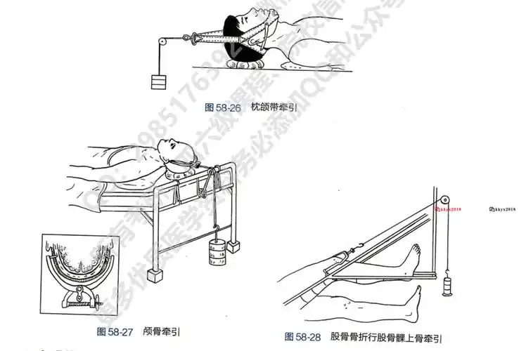 脚后跟|杠铃片|牵引|钢针|胫骨|骨折|-健康界