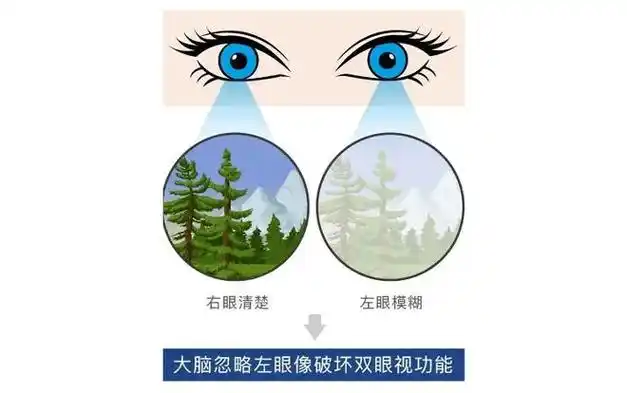 孩子屈光参差控制近视可以这样配镜