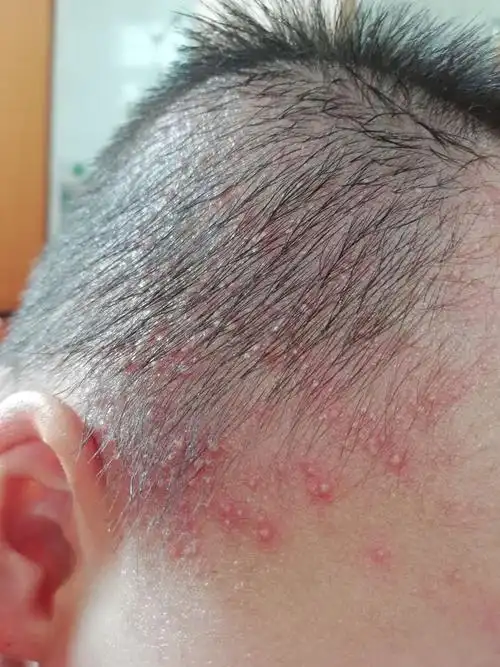 小儿推拿杨晓炎炎夏日是痱子高发季节宝宝长痱子如何预防护理