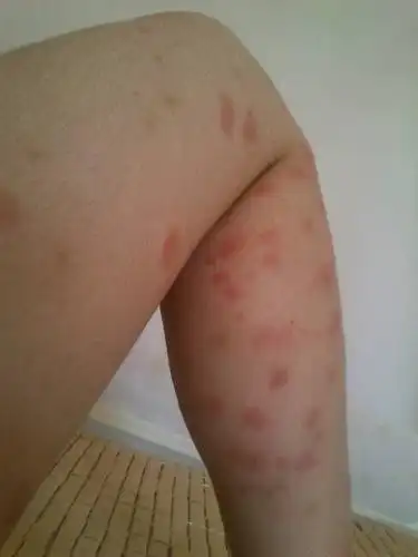 被吸血的臭虫咬了一个晚上起了很多又红又肿的包