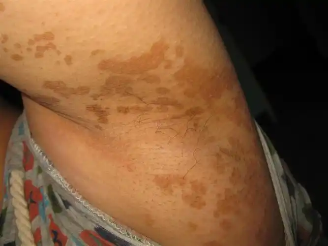 都是汗斑吗?为啥不一样?