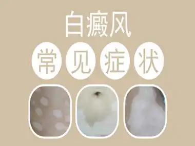 发展期间白癜风的症状是什么样的