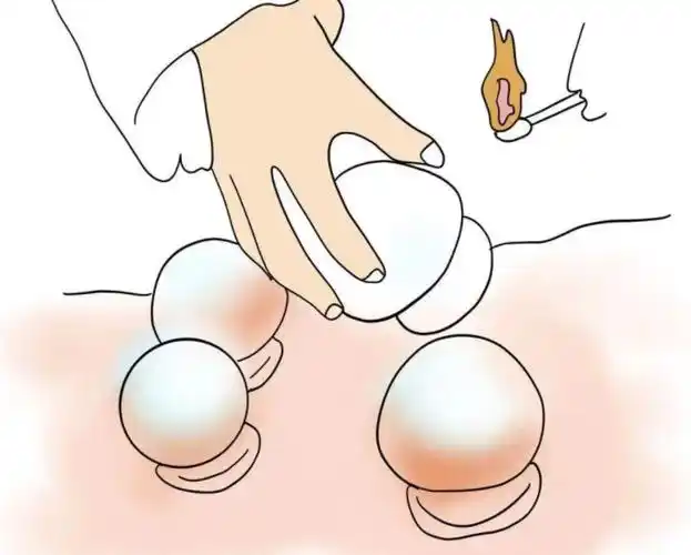 拔罐是以罐为工具,利用燃火,抽气等方法产生负压,使之吸附于体表,造成