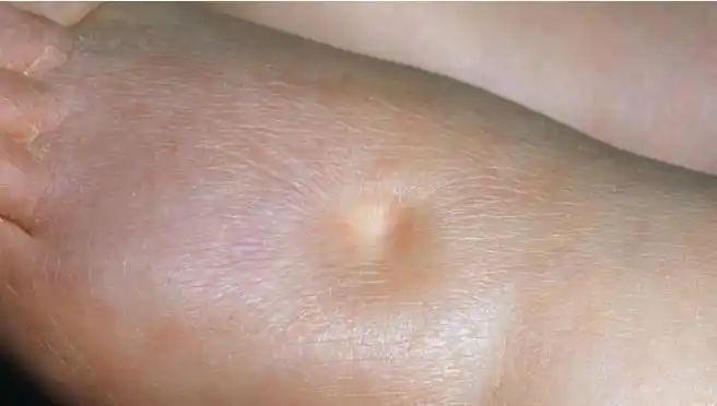 肾病常见的症状表现和体征变化二水肿高血压