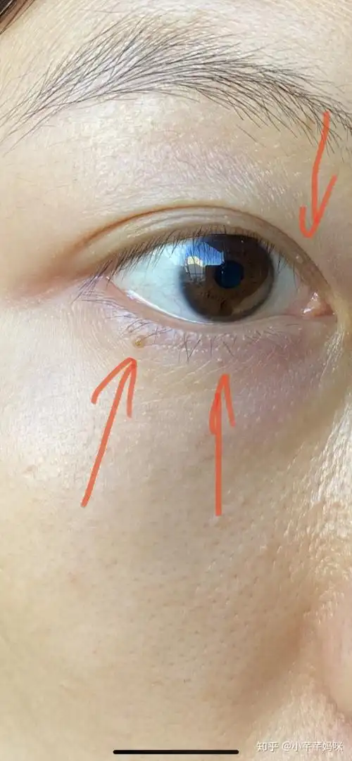 但却相同  于一样平常 意义  的粉刺脂肪粒的年夜 名 鸣 做  粟丘疹