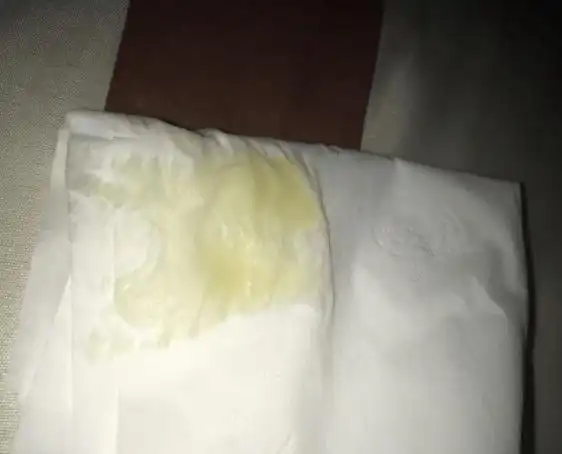 如果分泌物中掺杂有血丝,那就很有可能是因为hpv发生病变引起的,病毒