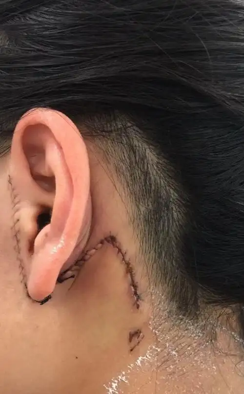 我总花费大概21000左右. 医生给我伤口消了毒.