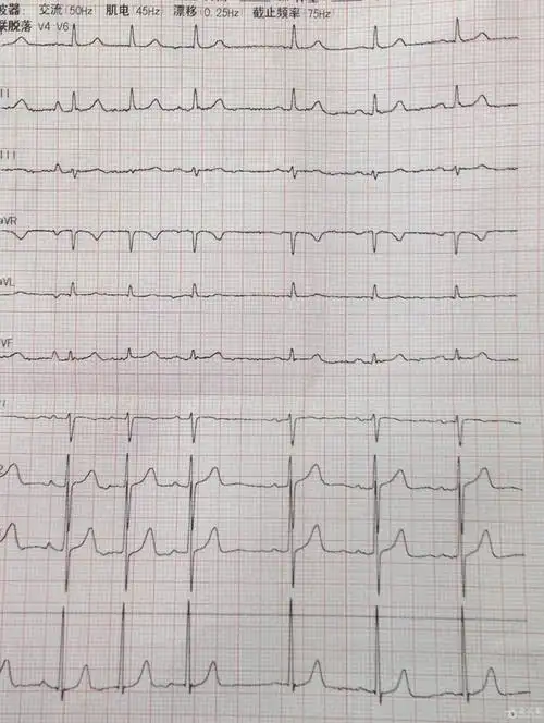 心电图 求解? - 心血管内科讨论版 - 爱爱医医学论坛