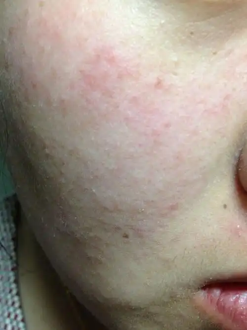 情绪激动脸有过敏症状为什么 - 全百科