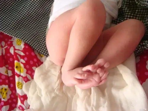 【原创】看看这是马凡氏综合征吗? [病例帖]