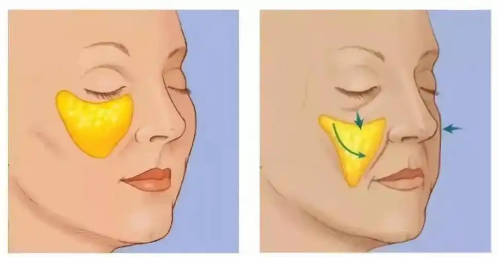 西安画美医疗美容医院——苹果肌下垂一厘米,人老10岁!