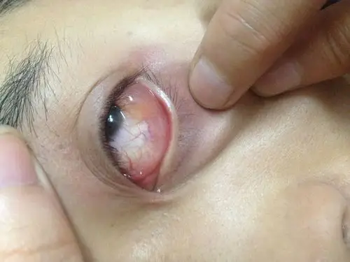 每次一有线状物都很疼,今天眼睛里面突然长出了肉瘤,该怎么办,什么